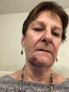 woman bruised chin