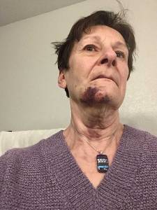 woman bruised chin